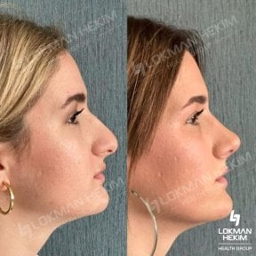 Before and after open rhinoplasty results at Lokman Hekim Istanbul Hospital, nose reshaping