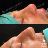 Before and after open rhinoplasty results at Lokman Hekim Istanbul Hospital, nose reshaping
