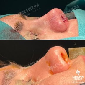 Before and after open rhinoplasty results at Lokman Hekim Istanbul Hospital, nose reshaping