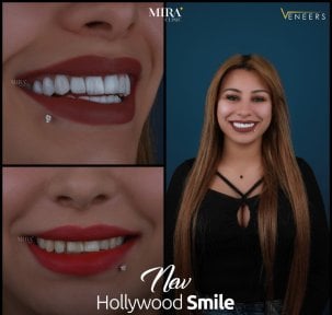 Hollywood Smile veneers before and after results at Mira Clinic for smile transformation