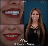 Hollywood Smile veneers before and after results at Mira Clinic for smile transformation