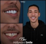 Before and after veneers result at Mira Clinic, Hollywood Smile transformation for men