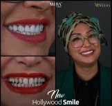 Before and after veneers results at Mira Clinic, Hollywood smile transformation
