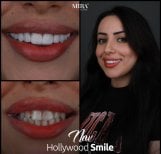 Before and after veneers results at Mira Clinic, Hollywood Smile transformation