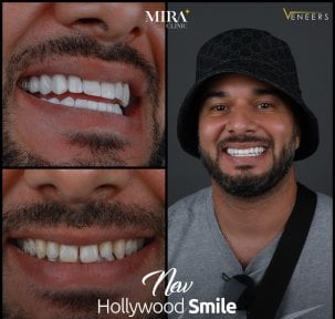 Before and after veneers results at Mira Clinic, Hollywood Smile transformation for men