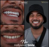 Before and after veneers results at Mira Clinic, Hollywood Smile transformation for men