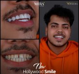 Before and after veneers result at Mira Clinic – Hollywood smile transformation for men