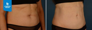 Before and after liposuction 3 body areas at Lokman Hekim Istanbul Hospital, visible contour result