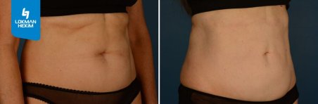 Before and after liposuction 3 body areas at Lokman Hekim Istanbul Hospital, visible contour result