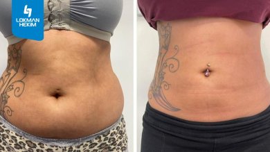 Before and after liposuction 3 body areas at Lokman Hekim Istanbul Hospital, visible contour result