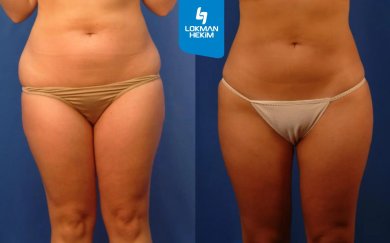 Before and after liposuction 3 body areas at Lokman Hekim Istanbul Hospital, visible contour result
