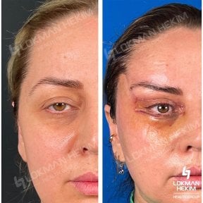 Resultados de blefaroplastia de párpado inferior antes y después en Lokman Hekim Estambul