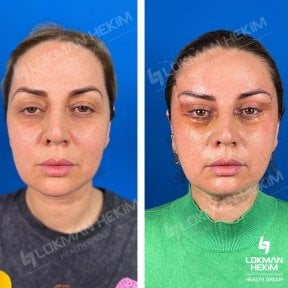 Resultados de blefaroplastia de párpado inferior antes y después en Lokman Hekim Estambul