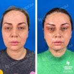 Resultados de blefaroplastia de párpado inferior antes y después en Lokman Hekim Estambul