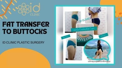 before-after photo vaser-liposuction