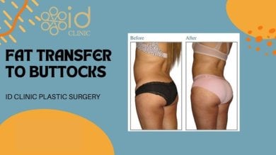 before-after photo vaser-liposuction