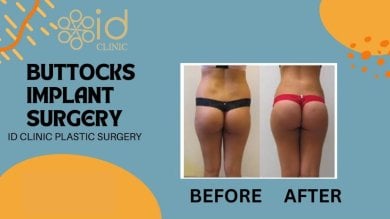 before-after photo vaser-liposuction