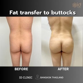 before-after photo vaser-liposuction