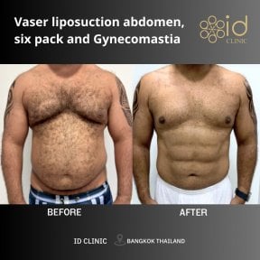 before-after photo vaser-liposuction