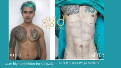 before-after photo vaser-liposuction