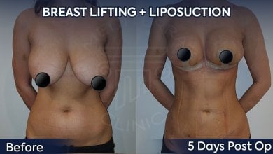 before-after photo 360-liposuction