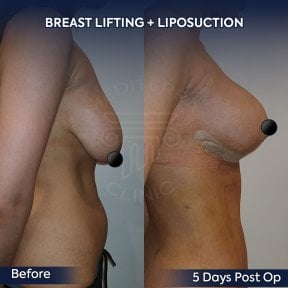 before-after photo 360-liposuction