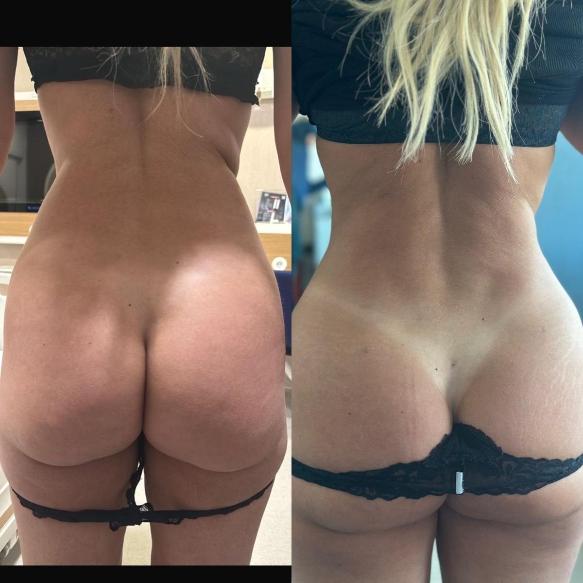 Resultados antes y después de Brazilian Butt Lift en Lokman Hekim Istanbul Hospital, forma mejorada