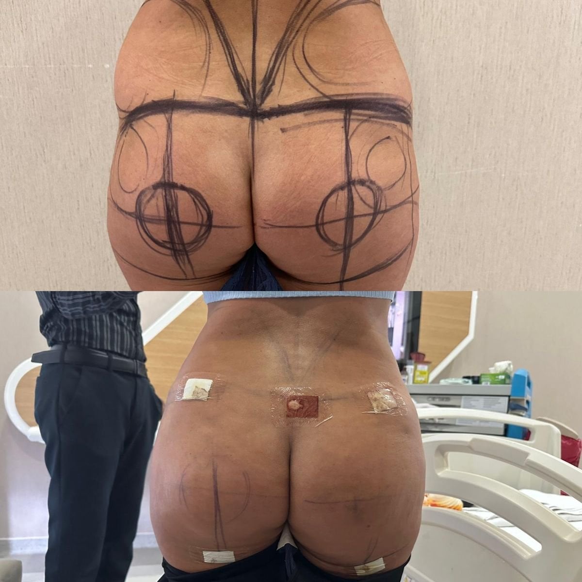نتائج قبل وبعد عملية Brazilian Butt Lift في مستشفى لوكمان حكيم إسطنبول، تحسين الشكل