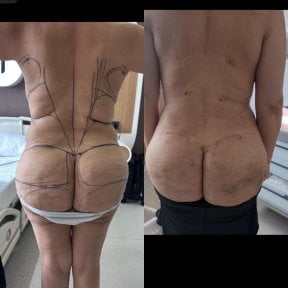 before-after photo brazilian-butt-lift