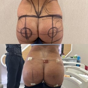 before-after photo brazilian-butt-lift