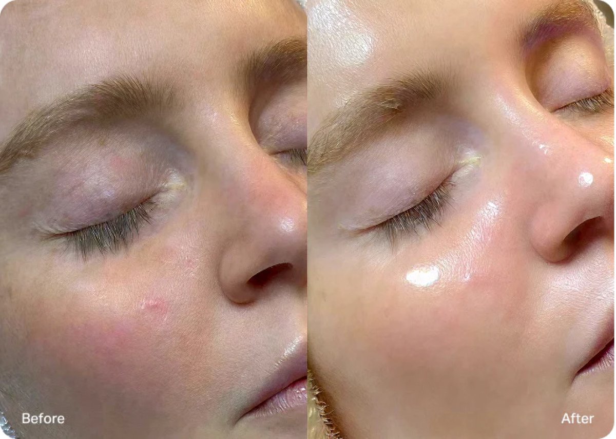 Resultados antes y después de la terapia de luz roja: mejora de textura y brillo facial