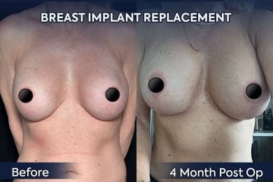 before-after photo mastopexy-breast-lift-contour-plastics