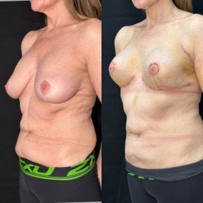 before-after photo mastopexy-breast-lift-contour-plastics