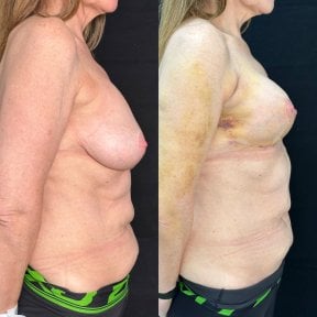 before-after photo mastopexy-breast-lift-contour-plastics