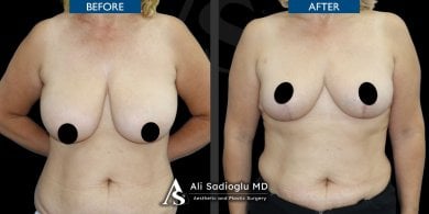 before-after photo mastopexy-breast-lift-contour-plastics