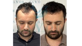 Before and after hair transplant result at Este Favor Hair Transplant Center, improved hairline