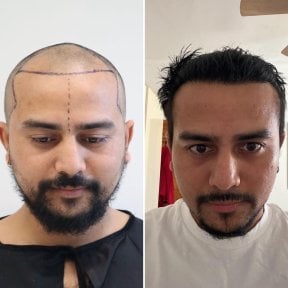 Before and after hair transplant results at Este Favor Hair Transplant Center, restored hairline