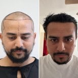 Before and after hair transplant results at Este Favor Hair Transplant Center, restored hairline