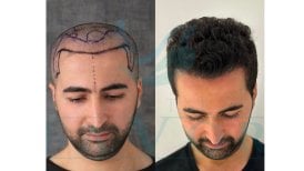 Before and after hair transplant result at Este Favor Hair Transplant Center, restored hairline