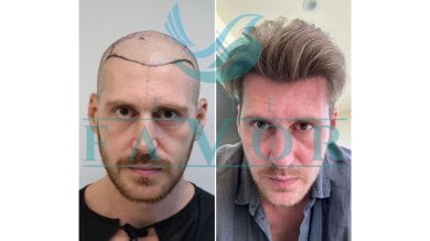 Before and after hair transplant results at Este Favor Hair Transplant Center, restored hairline