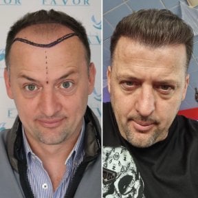 Before and after hair transplant result at Este Favor Hair Transplant Center, restored hairline