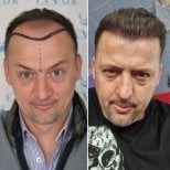 Before and after hair transplant result at Este Favor Hair Transplant Center, restored hairline