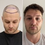 Before and after hair transplant results at Este Favor Hair Transplant Center, restored hairline