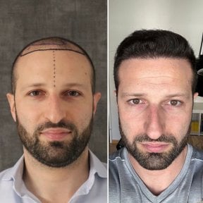 Before and after hair transplant result at Este Favor Hair Transplant Center, restored hairline