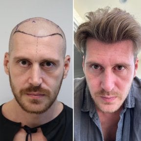 Before and after hair transplant result at Este Favor Hair Transplant Center, restored hairline