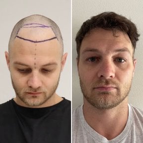 Before and after hair transplant result at Este Favor Hair Transplant Center, restored hairline