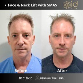 before-after photo tightening-of-facial-skin-facelift
