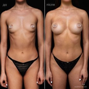 before-after photo mammoplasty