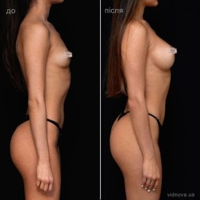 before-after photo mammoplasty
