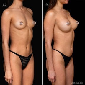 before-after photo mammoplasty